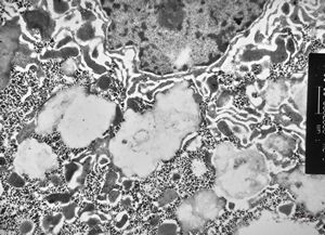 F,7m. | giant cell hepatitis F,7m. | giant cell hepatitis